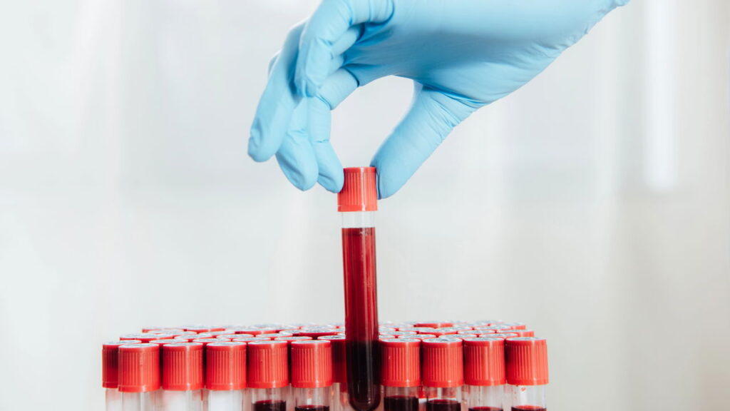 Sangue dourado, o fenômeno raríssimo que intriga cientistas e médicos