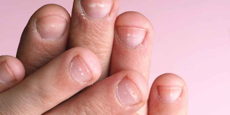 As causas ocultas por trás das manchas brancas nas unhas
