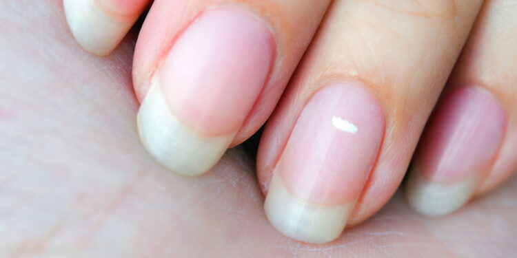 Você tem manchas brancas nas unhas? Saiba o que elas revelam sobre sua saúde